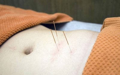 Best Acupuncture Treatment in Frisco TX