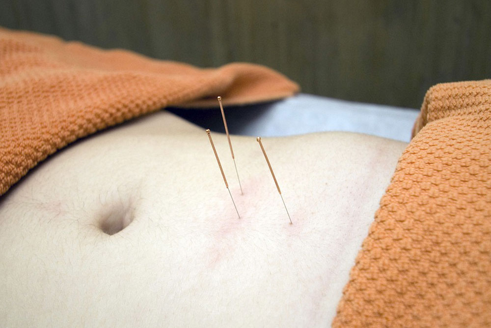 15i Best Acupuncture Treatment in Frisco TX